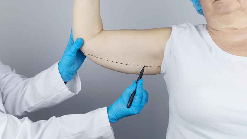 Milton Seigi Hayashi reforça que o lifting de braço remodela a região com técnicas avançadas para resultados mais definidos.